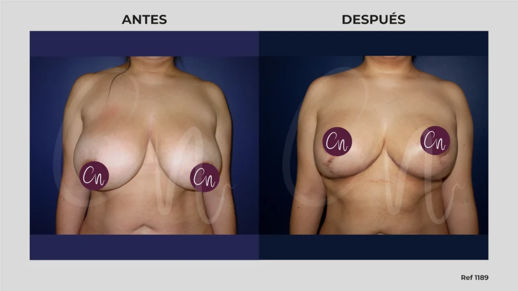 foto corrección de asimetría mamaria