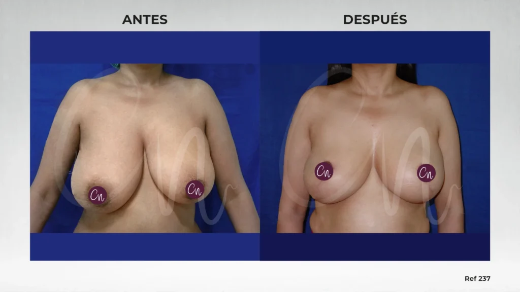 antes y después corrección de asimetría mamaria