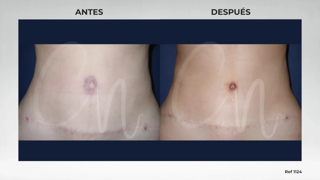foto cirugía umbilical