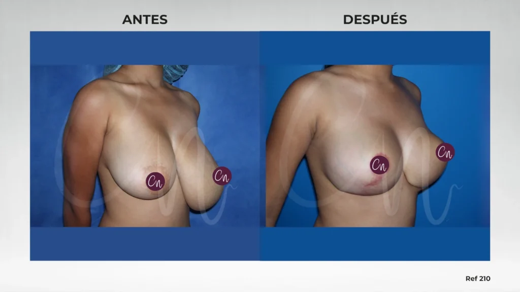 foto mamas asimétricas