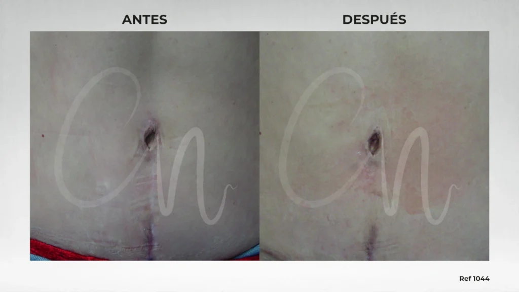 foto ombligo reconstrucción