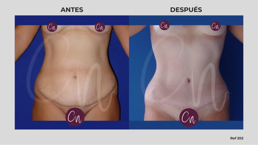 foto reconstrucción del ombligo