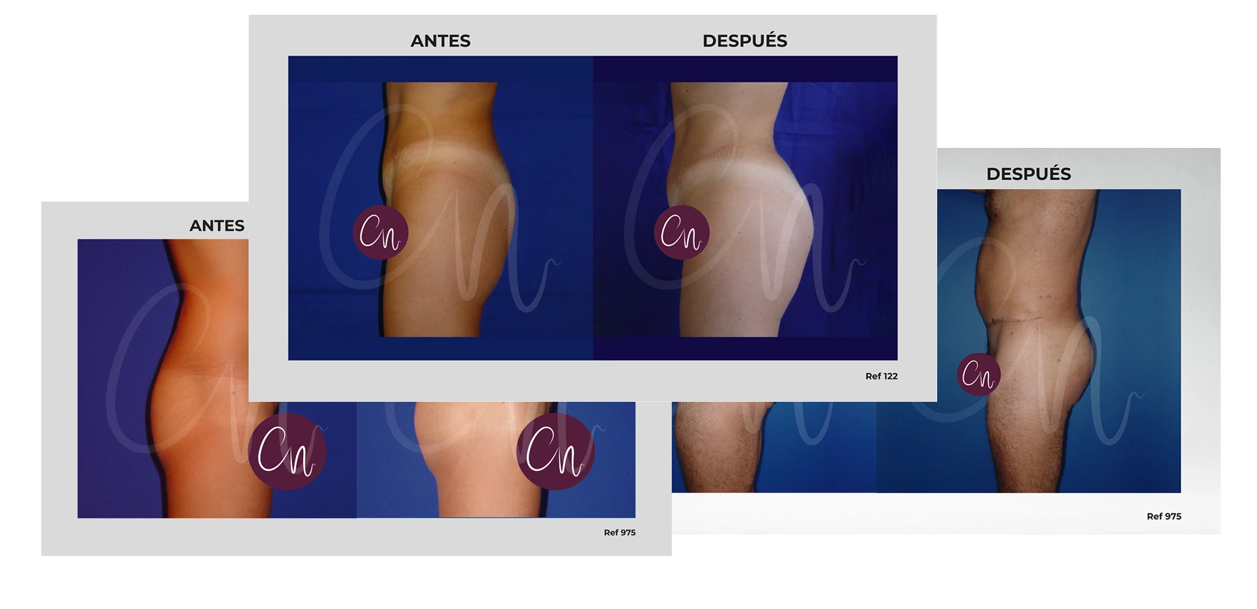 Casos Gluteoplastia con implante galería