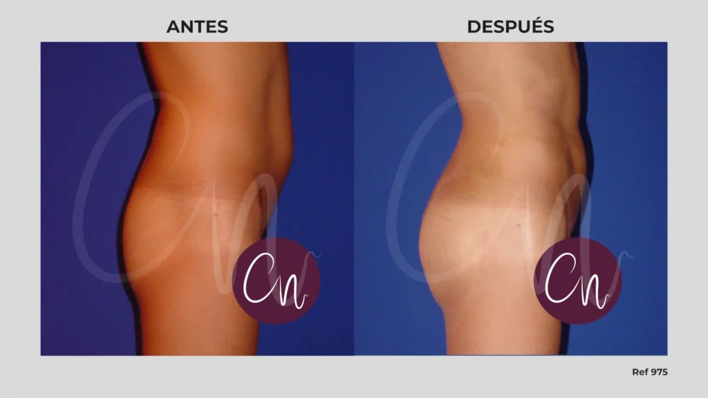 gluteoplastia resultados reales