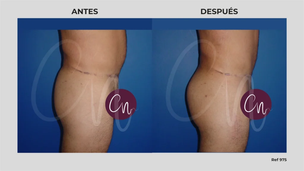 implantes de glúteos antes y después