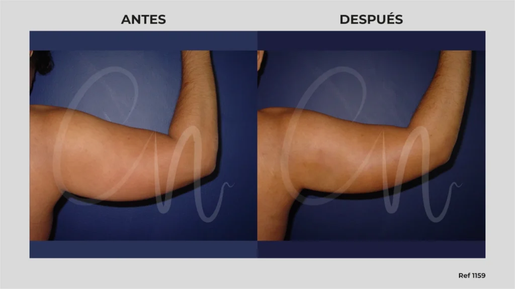 Lipo brazos caso