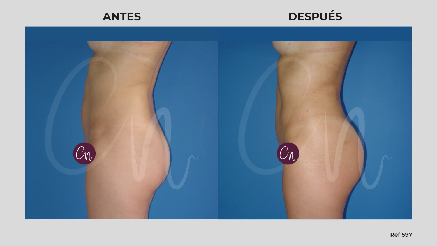 lipo en mujeres
